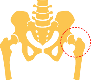 Fractured neck of femur