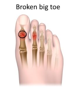 Broken big toe